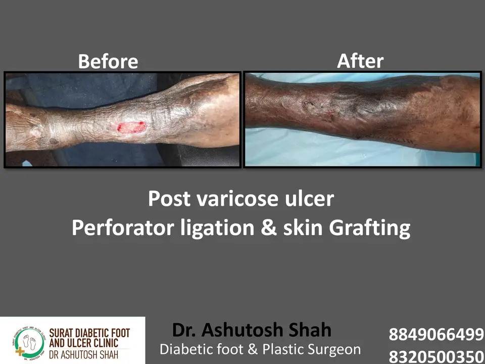 Varicose veins and Ulcers.pptx-10.webp